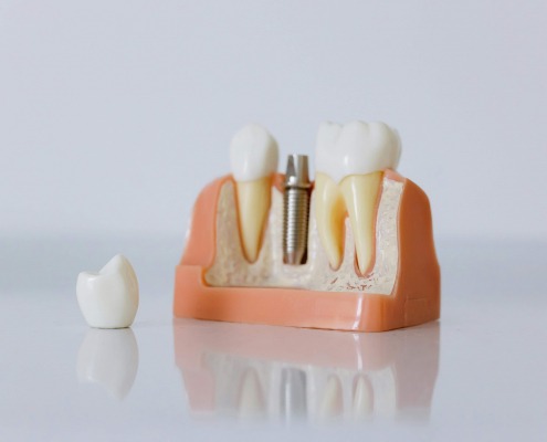 Wie lange dauert die Heilung nach dem Setzen eines Implantats?